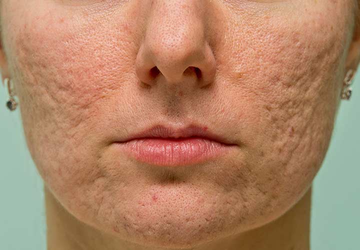 Acne Scar Removal Cost in Meerut  India