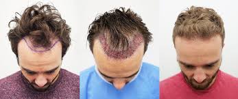 The Best Hair Transplant Cost In India.